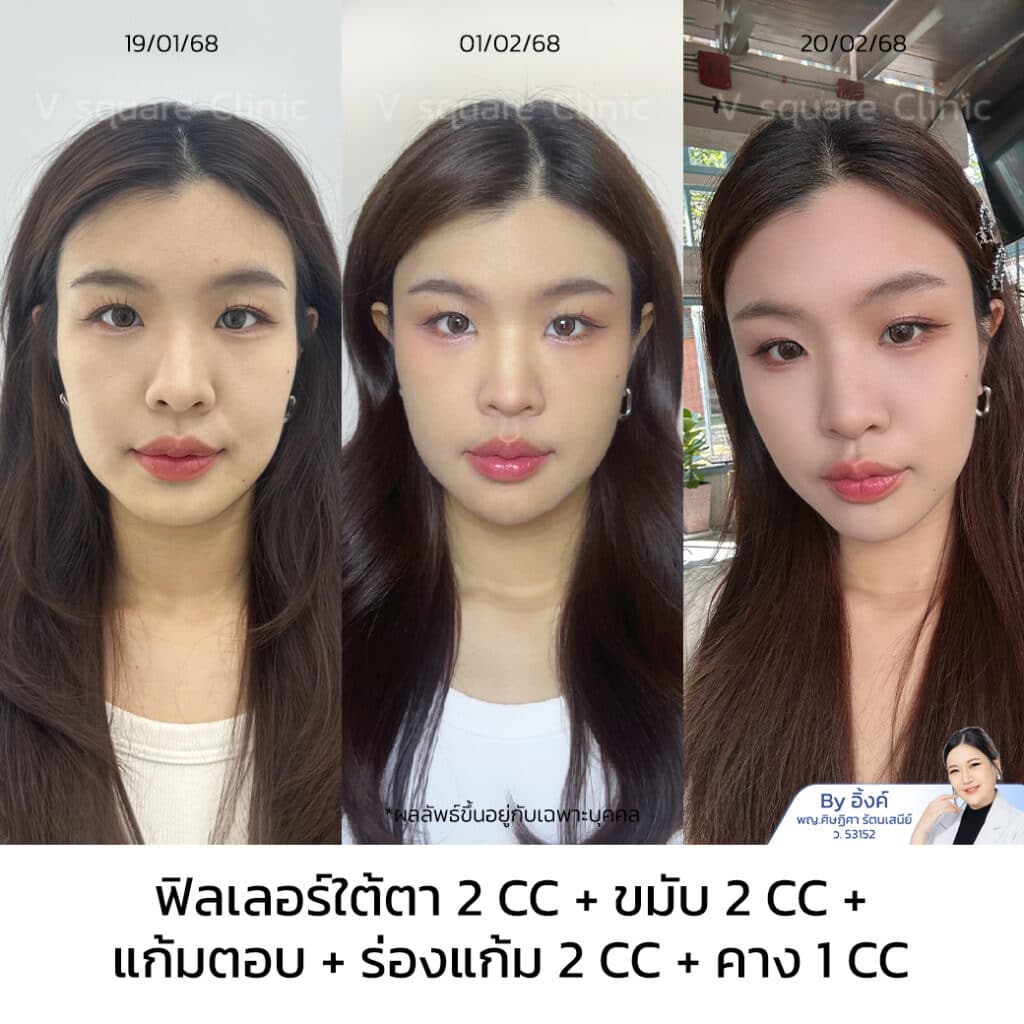 รีวิวฉีดฟิลเลอร์ใต้ตา(1)