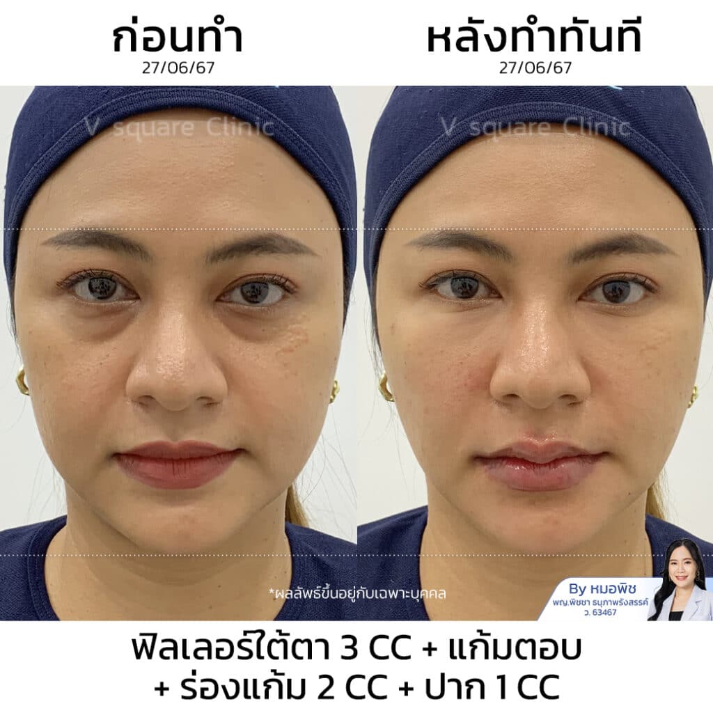 รีวิวฟิลเลอร์ร่องแก้ม_คุณแอน (ไม่มี Follow)