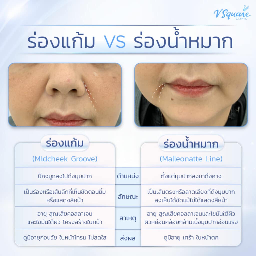 ร่องแก้มร่องน้ำหมาก