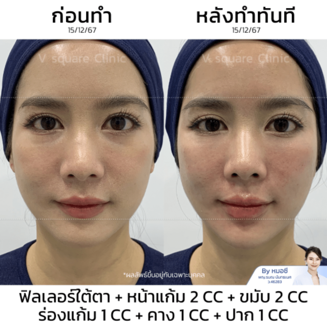 ฉีดฟิลเลอร์ under eye โดยหมอซี