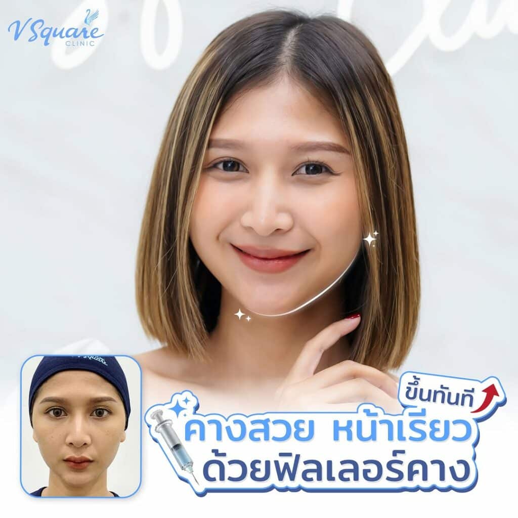 ฉีดฟิลเลอร์คาง คือ