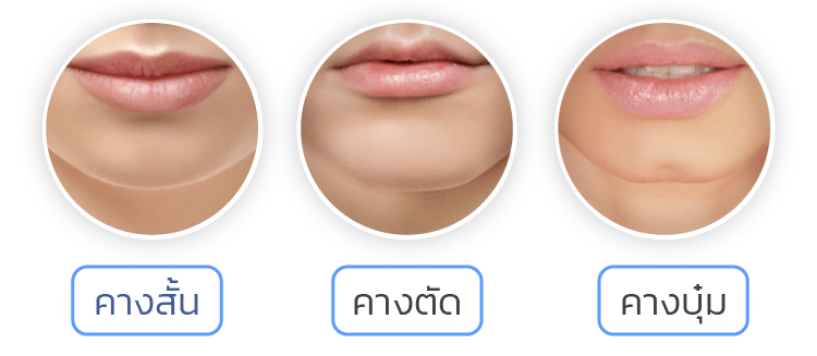 ฉีดฟิลเลอร์คาง เหมาะกับใคร