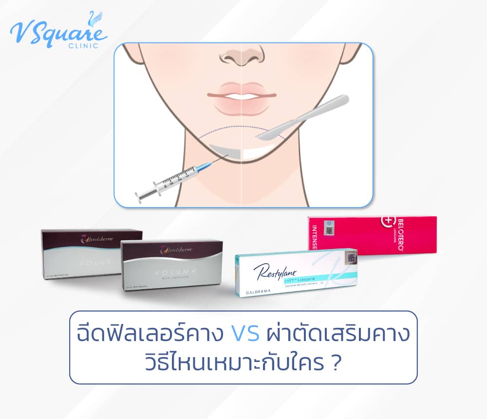 ฉีดฟิลเลอร์คาง