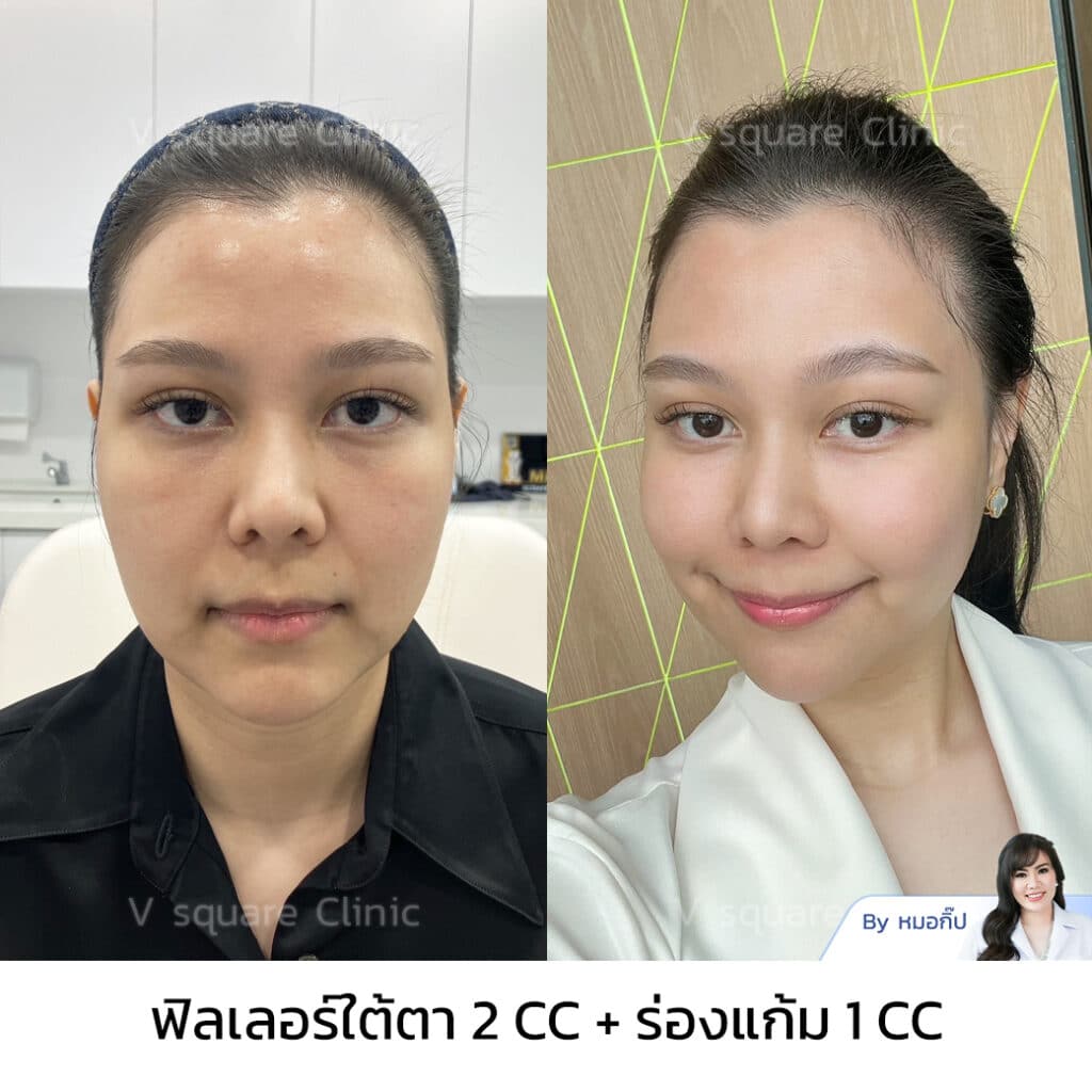 ฉีดฟิลเลอร์ร่องแก้ม_คุณจ๊ะโอ๋ อินฟลู