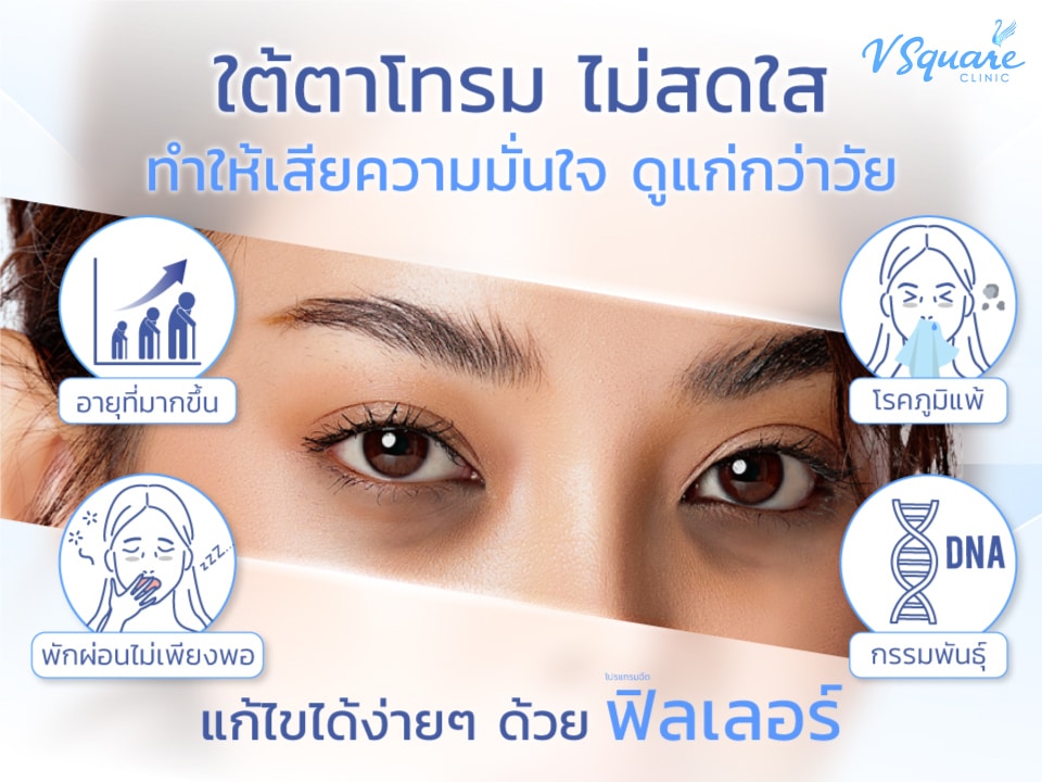 ฉีดใต้ตาด้วยฟิลเลอร์