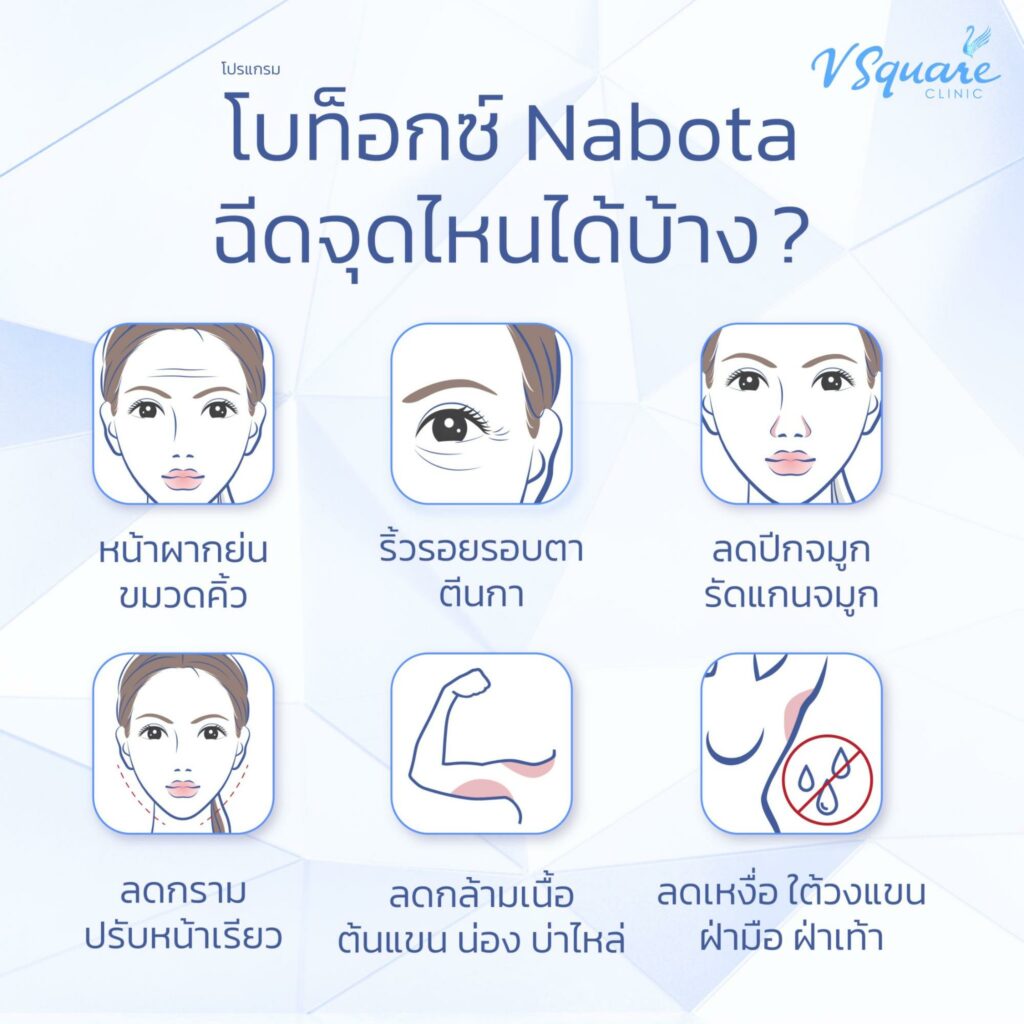 ตำแหน่งที่นิยมฉีดโบท็อก Nabota