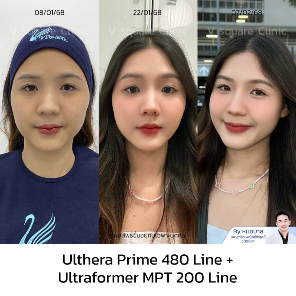 รีวิว Ulthera Prime_เอิร์น