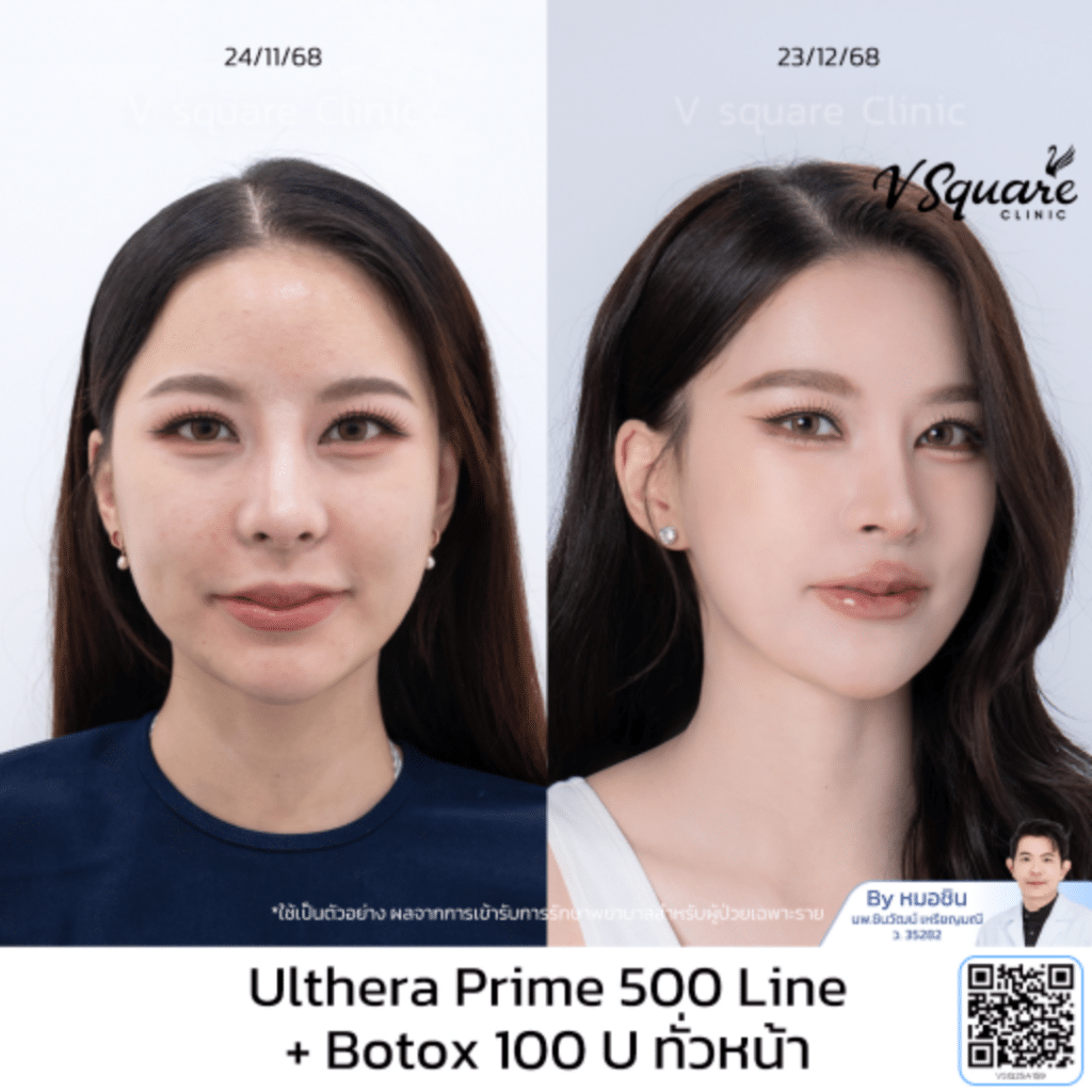 รีวิว Ulthera คุณปุยนุ่น โดยหมอชิน