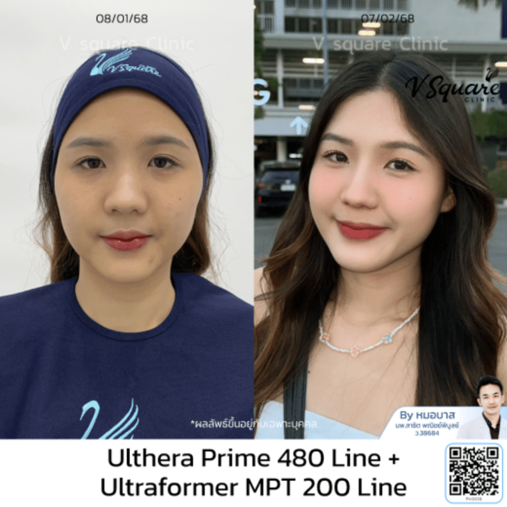 รีวิว Ulthera คุณเอิร์น โดยหมอบาส