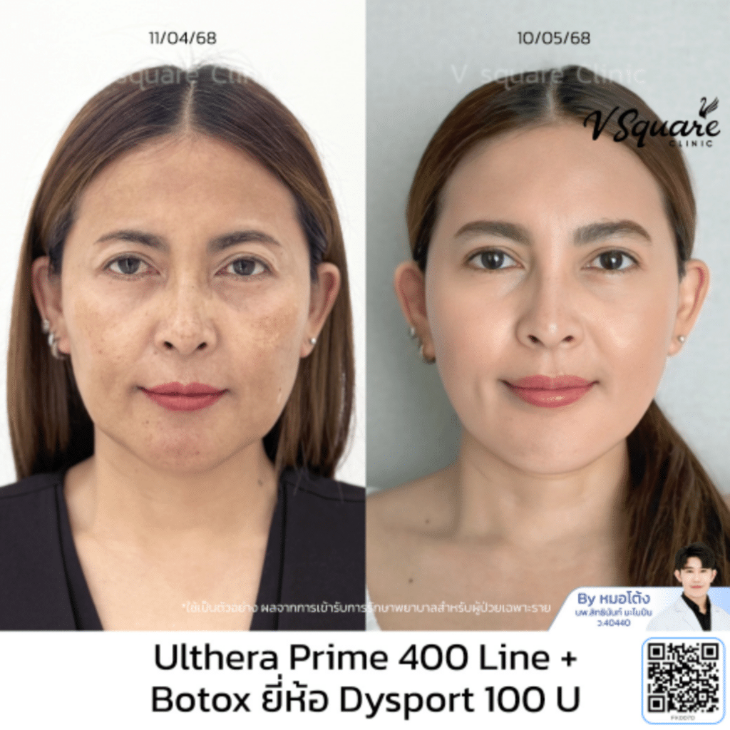 รีวิว Ulthera น้าพลอย โดยหมอโต้ง