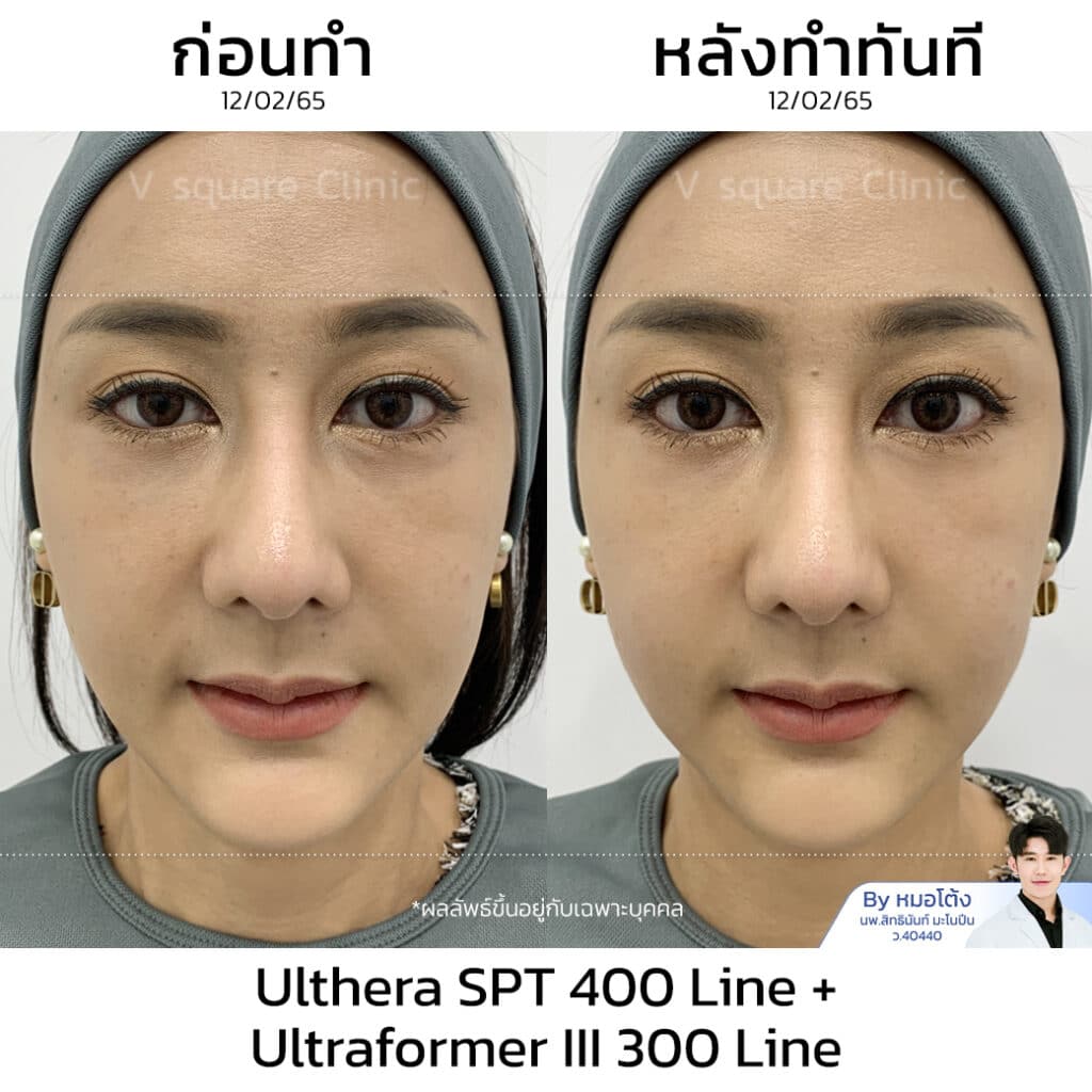 รีวิว Ulthera ผลลัพธ์หลังทำทันที_คุณตั๊ก แม่ค้า Brandname