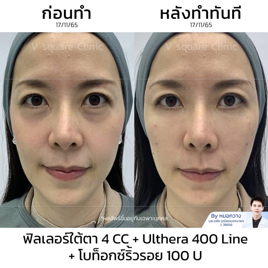 รีวิว Ulthera ผลลัพธ์หลังทำทันที_คุณบิ๊ว Tiktoker
