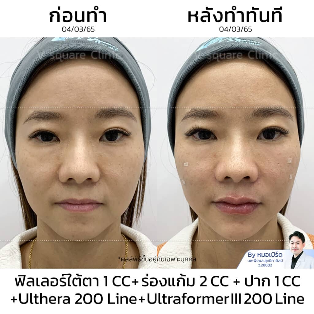 รีวิว Ulthera ผลลัพธ์หลังทำทันที_คุณแสง (Tiktoker)
