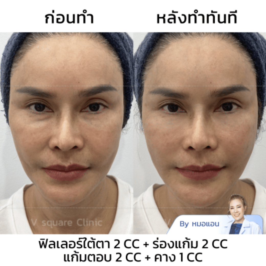 รีวิว ฉีด Filler คาง