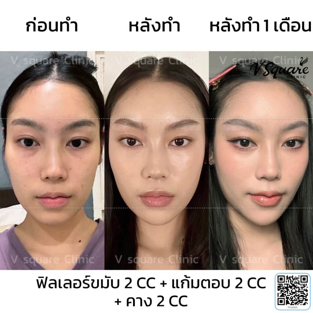 รีวิว ฉีดฟิลเลอร์คาง คุณนานามิ
