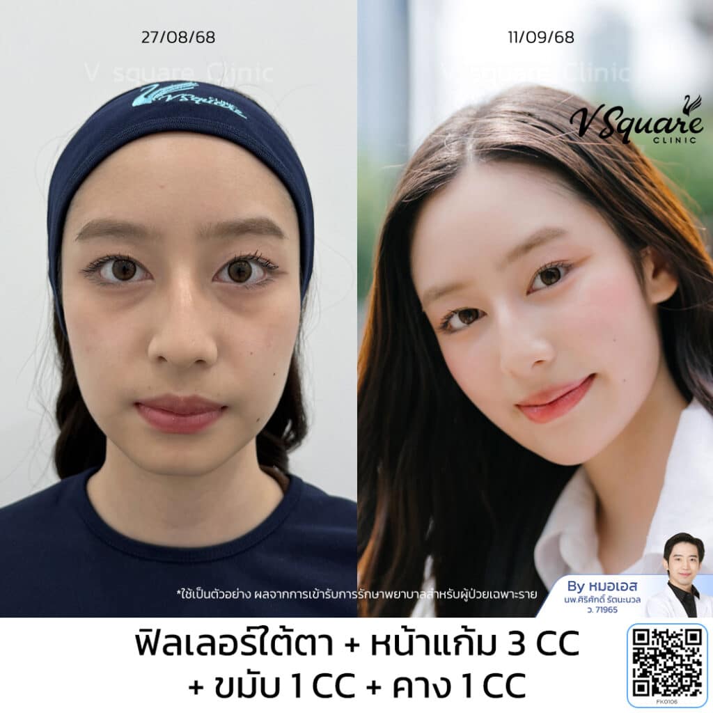 รีวิว ฉีดฟิลเลอร์คาง คุณแจกัน โดย หมอเอส