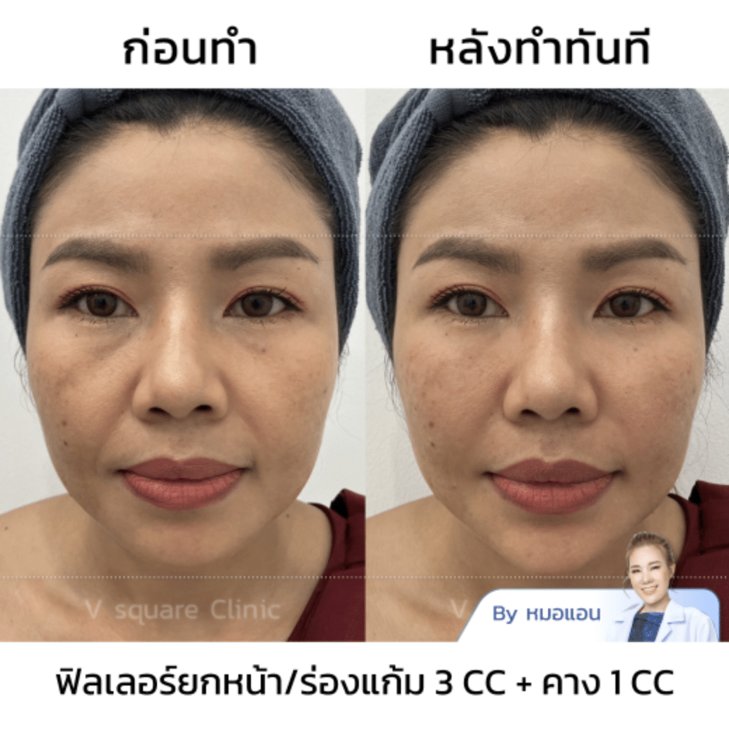 รีวิว ฉีดฟิลเลอร์คาง แก้คางยื่น