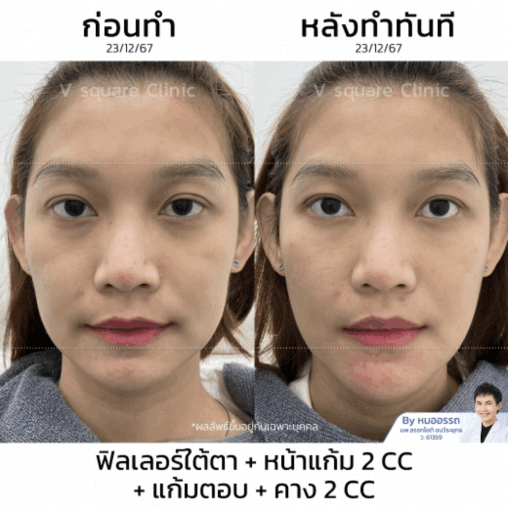 รีวิว ฉีดฟิลเลอร์คาง แก้คางสั้น