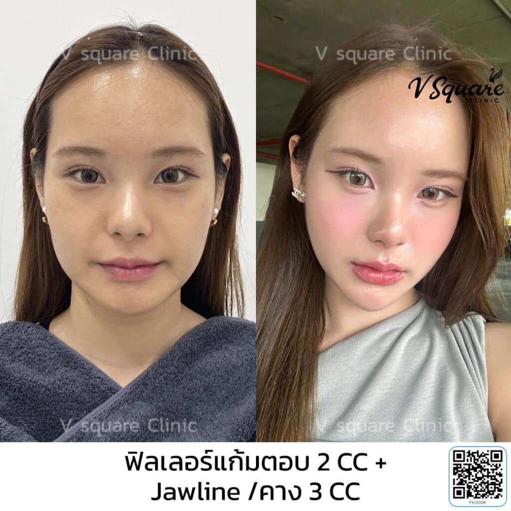 รีวิว ฉีดฟิลเลอร์คาง แก้คางสั้น_คุณเกล