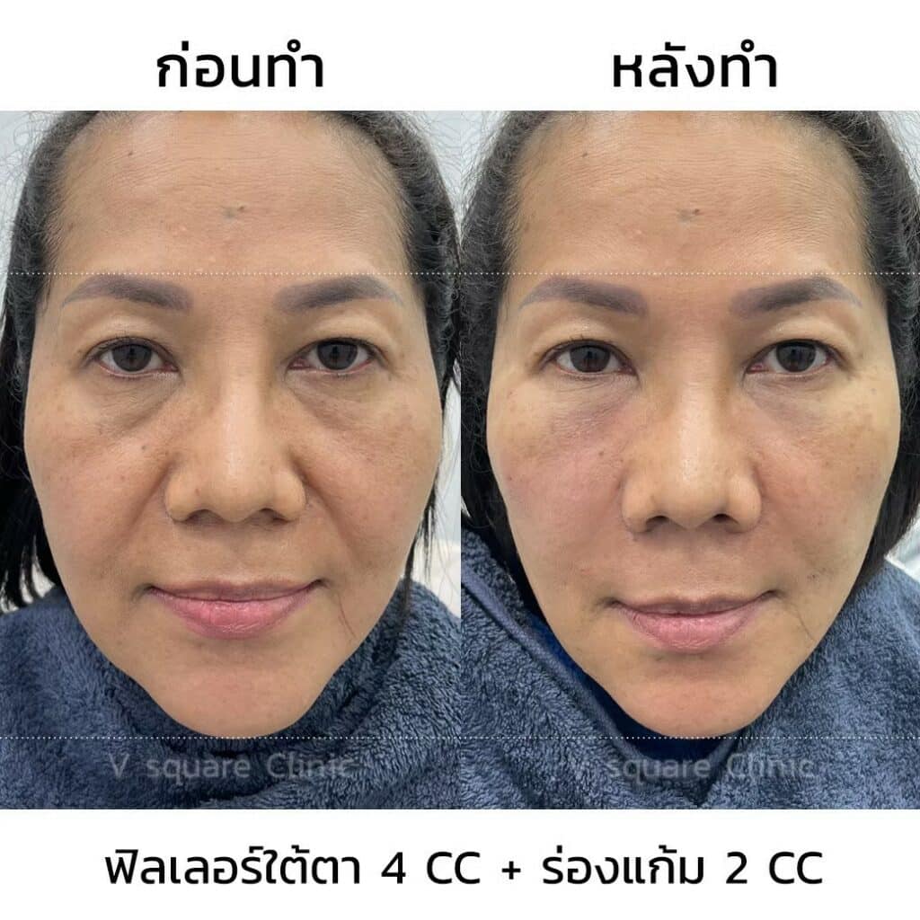 รีวิวฉีดฟิลเลอร์ใต้ตา