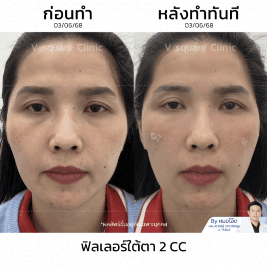 รีวิวฉีดฟิลเลอร์ใต้ตา_ฐานะมาศ โดยหมอโอ๊ต