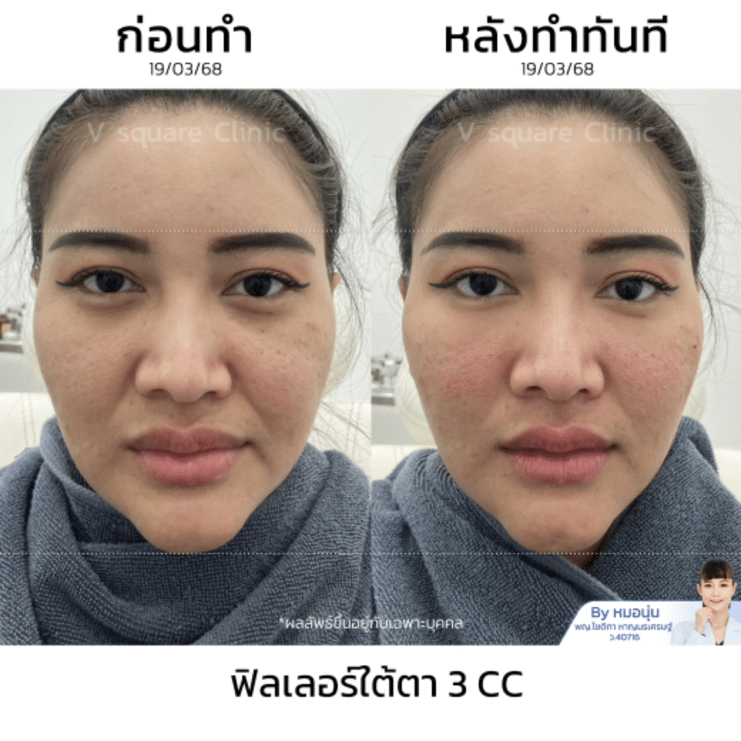 รีวิวฉีดฟิลเลอร์ใต้ตา_ณัฐธิดา โดยหมอนุ่น