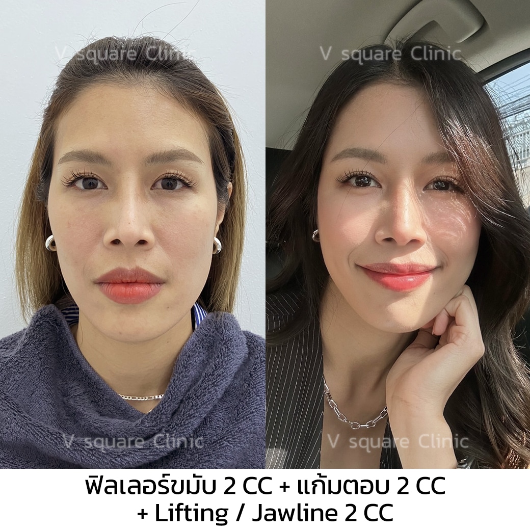 รีวิวฟิลเลอร์ขมับ_คุณต้นเตย อินฟลู