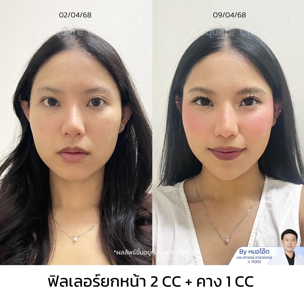 รีวิวฟิลเลอร์คาง 1 CC_แบมบู