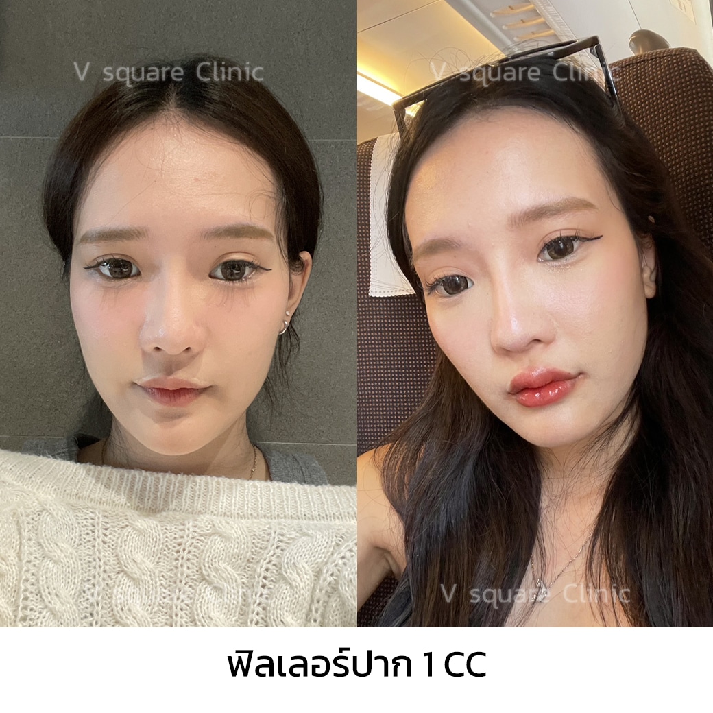 รีวิวฟิลเลอร์ปาก 1 CC_คุณโมกุล อินฟลู