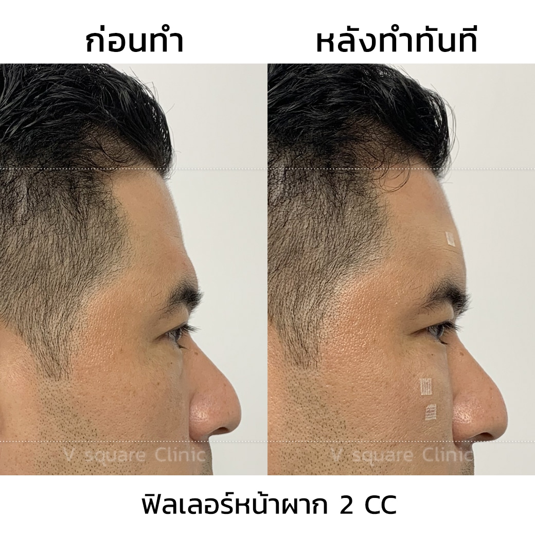 รีวิวฟิลเลอร์หน้าผาก 2 CC _คุณวูจู (Pronality)