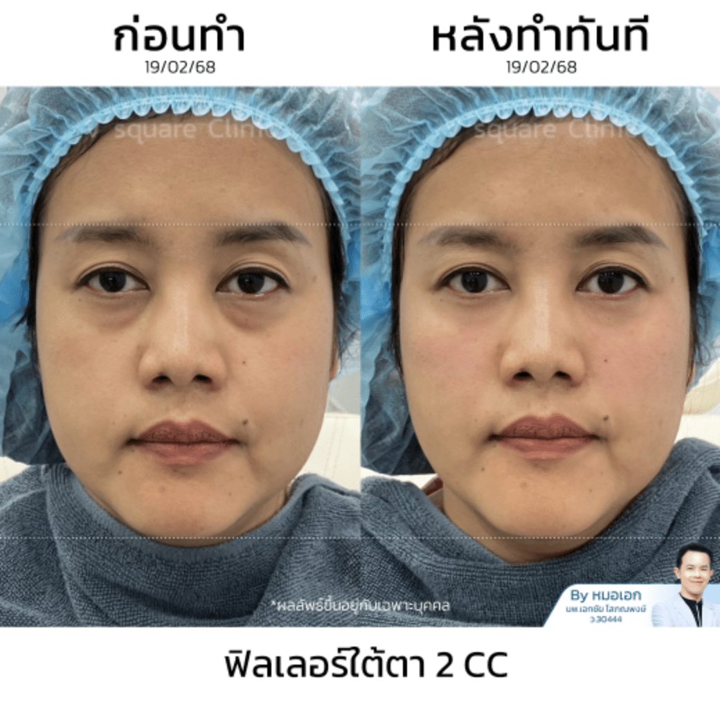 รีวิวเติมฟิลเลอร์ใต้ตา_สุพิชญา โดยหมอเอก