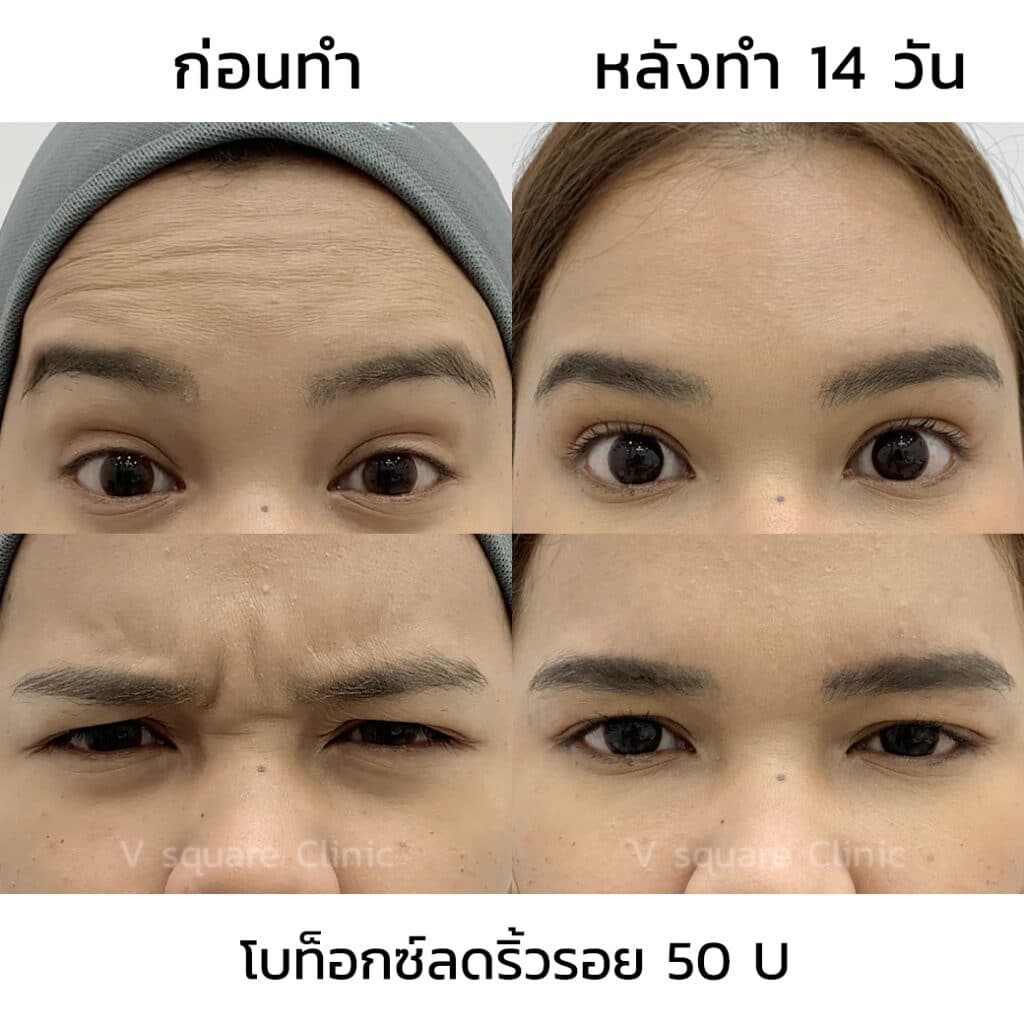 เคสโบท็อกซ์ริ้วรอย เฉพาะคิ้ว_มายด์
