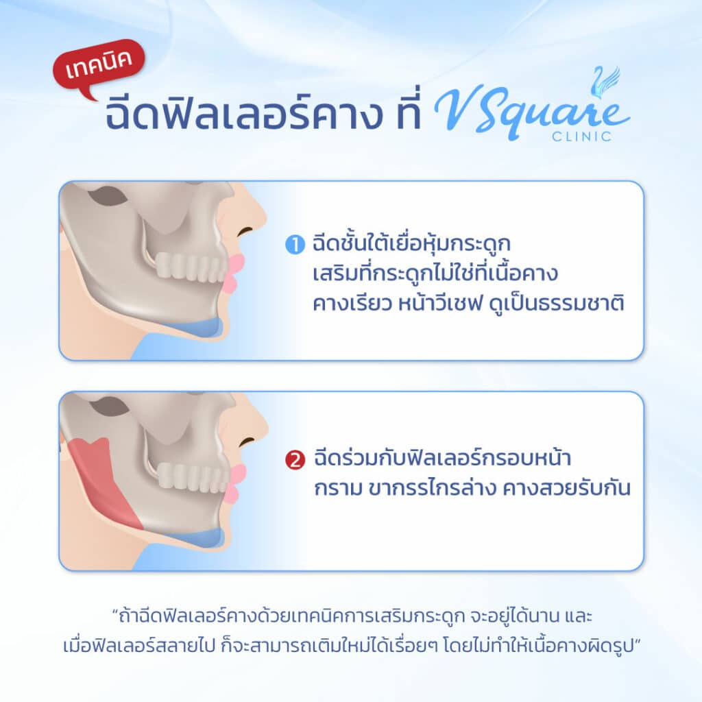 เทคนิคฉีดคาง เติมคาง
