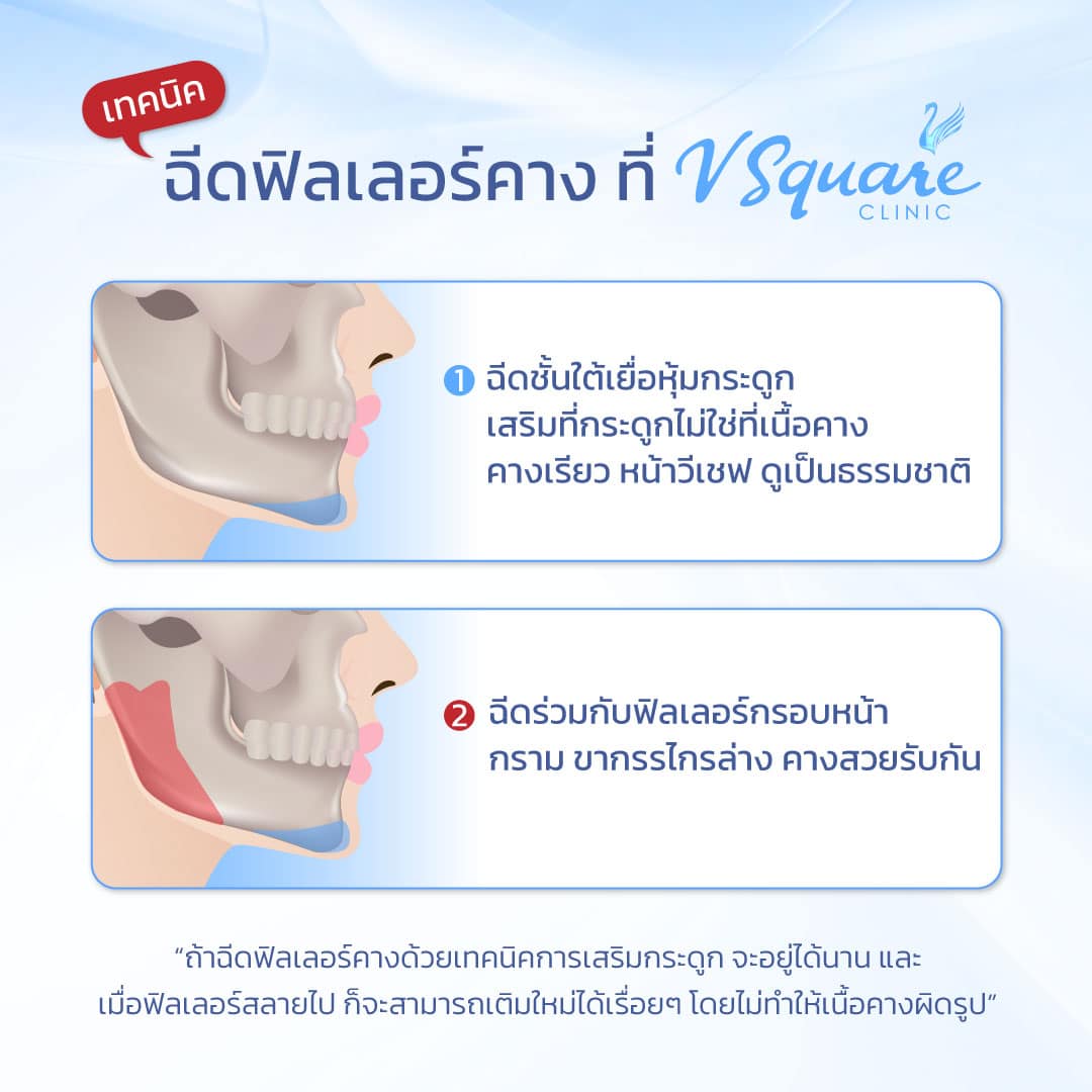 เทคนิคฉีดคาง เติมคาง