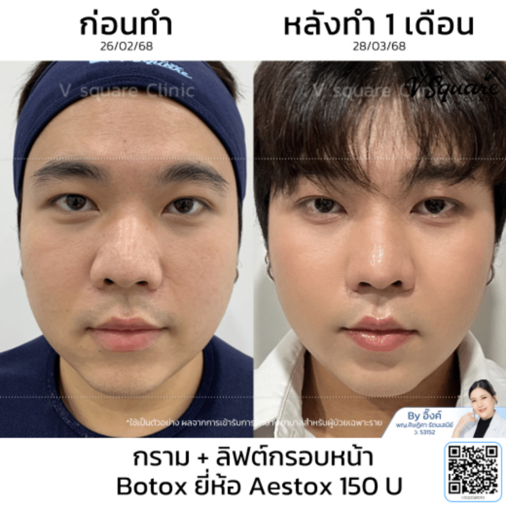 Botox Aestox Price_คุณรุ่ง_โดยหมออิ๊งค์