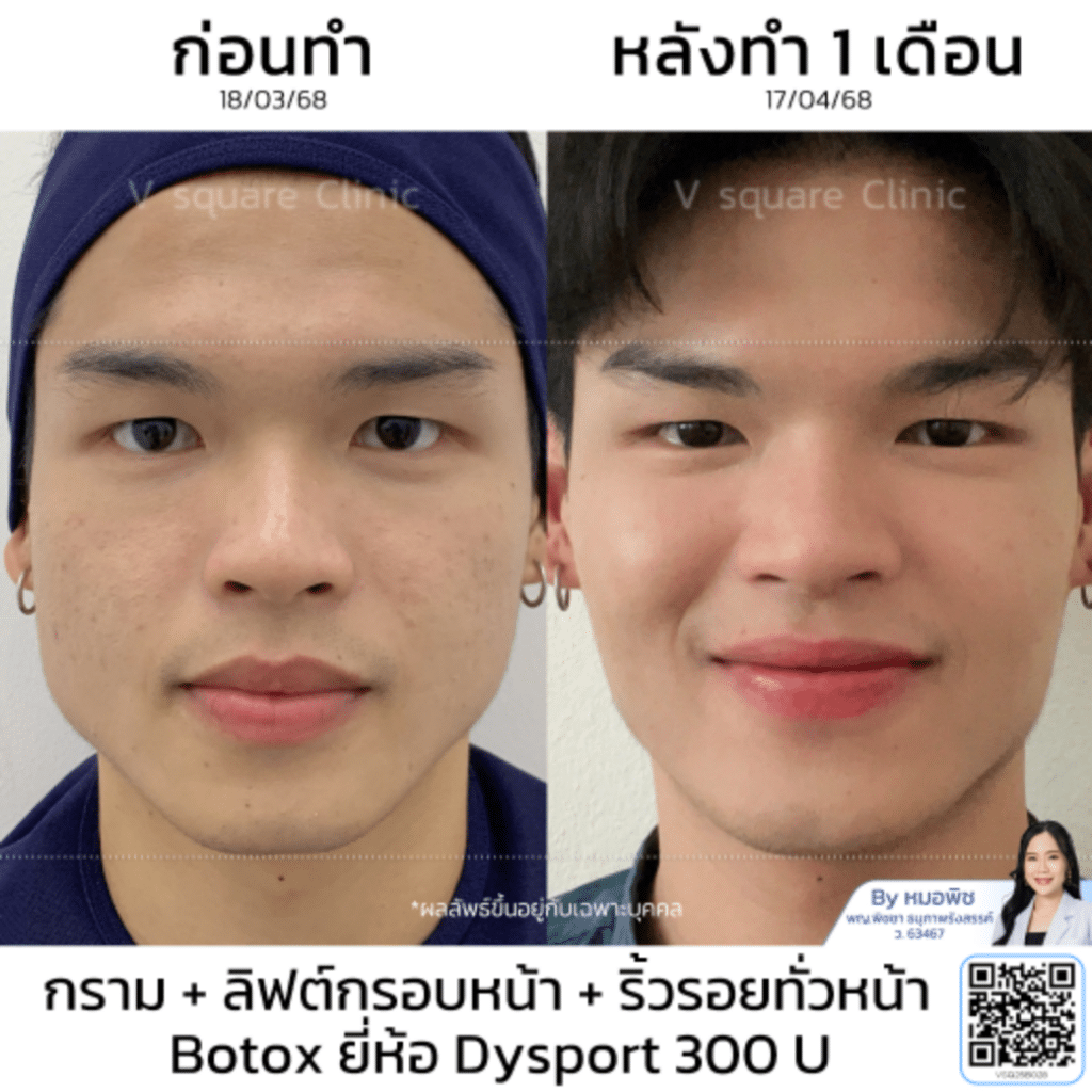 Botox Dysport Price_คุณบอส_โดยหมอพิช