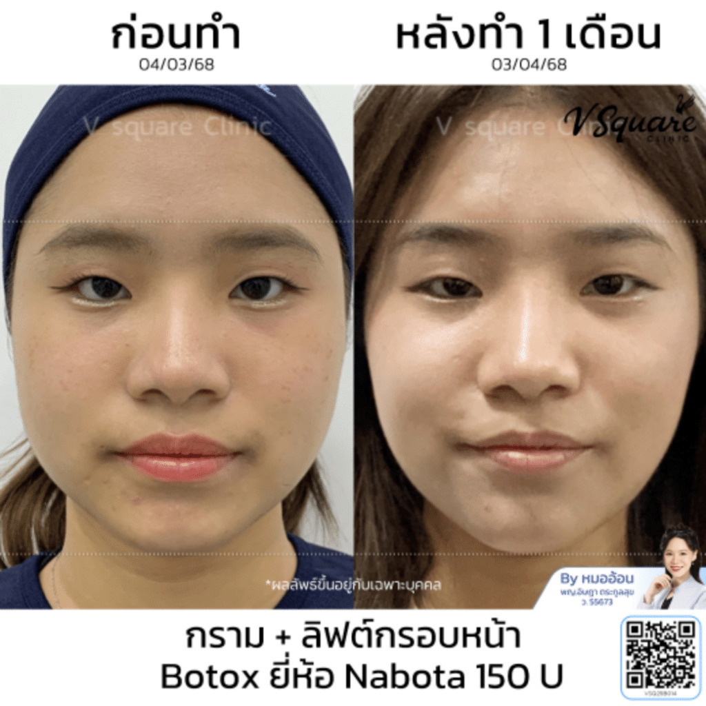 Botox Nabota Price_คุณนิ้งค์_โดยหมออ้อน