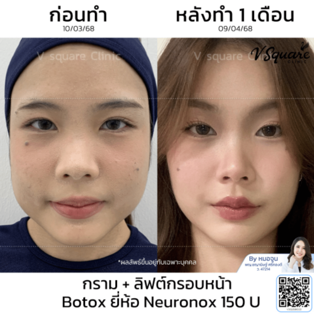 Botox Neuronox Price_คุณนิชา_โดยหมอจูน