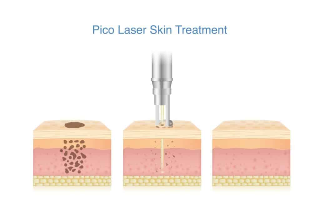 Picosure Pro Laser หลักการทำงาน