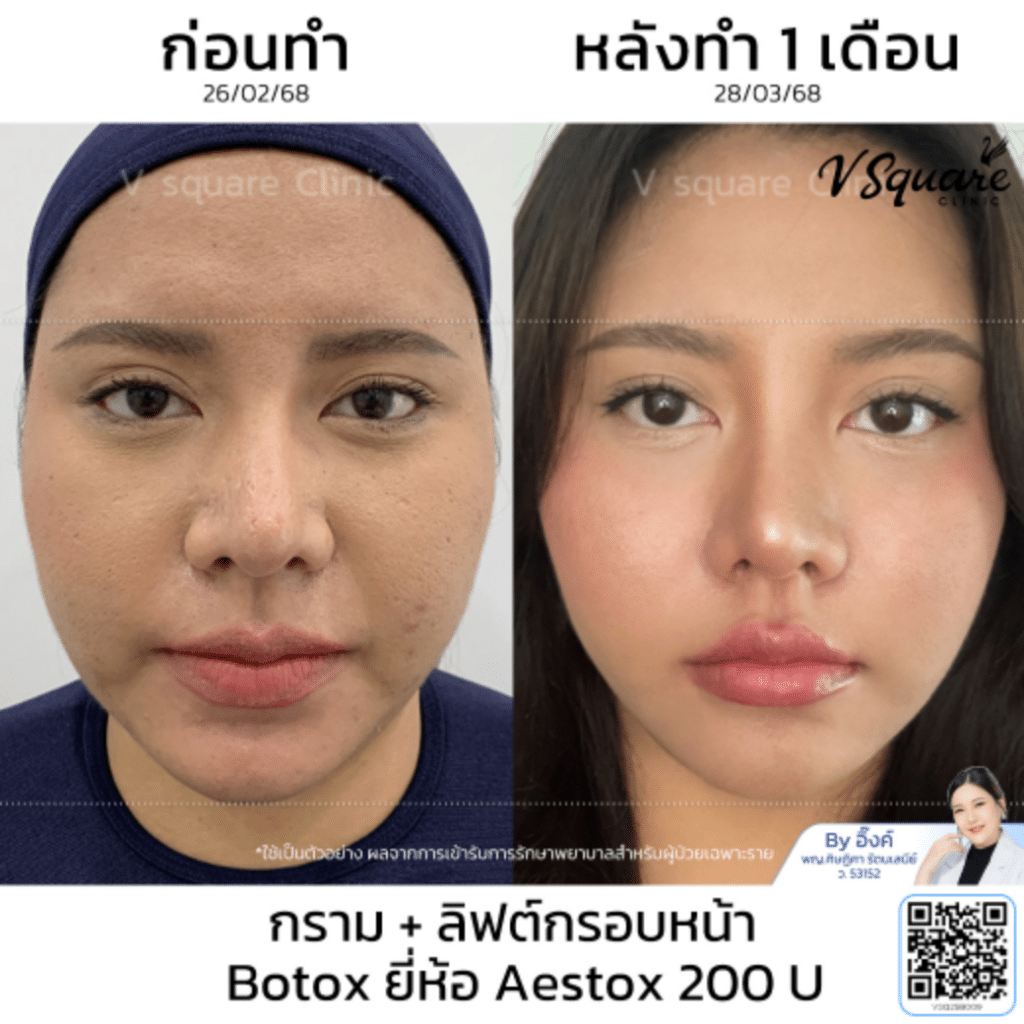 ฉีดโบท็อก Aestox ราคา_คุณแพม_โดยหมออิ๊งค์