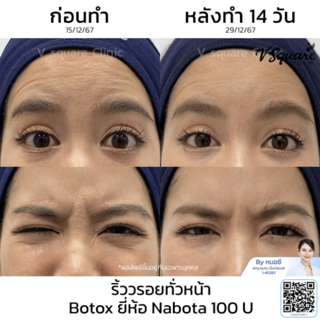 ฉีดโบท็อก Nabota ราคา_คุณยุ้ย_โดยหมอซี