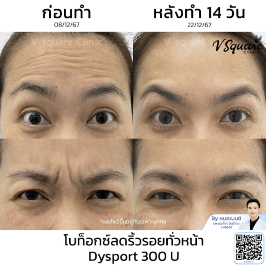ฉีดโบท็อกDysport ราคา_คุณจุฑามาศ_โดยหมอเบนซ์