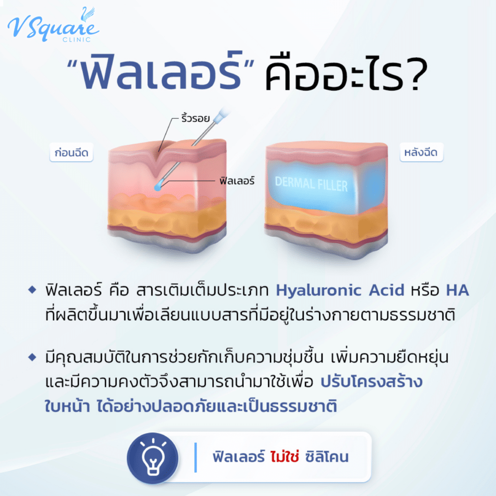 ฟิลเลอร์คืออะไร