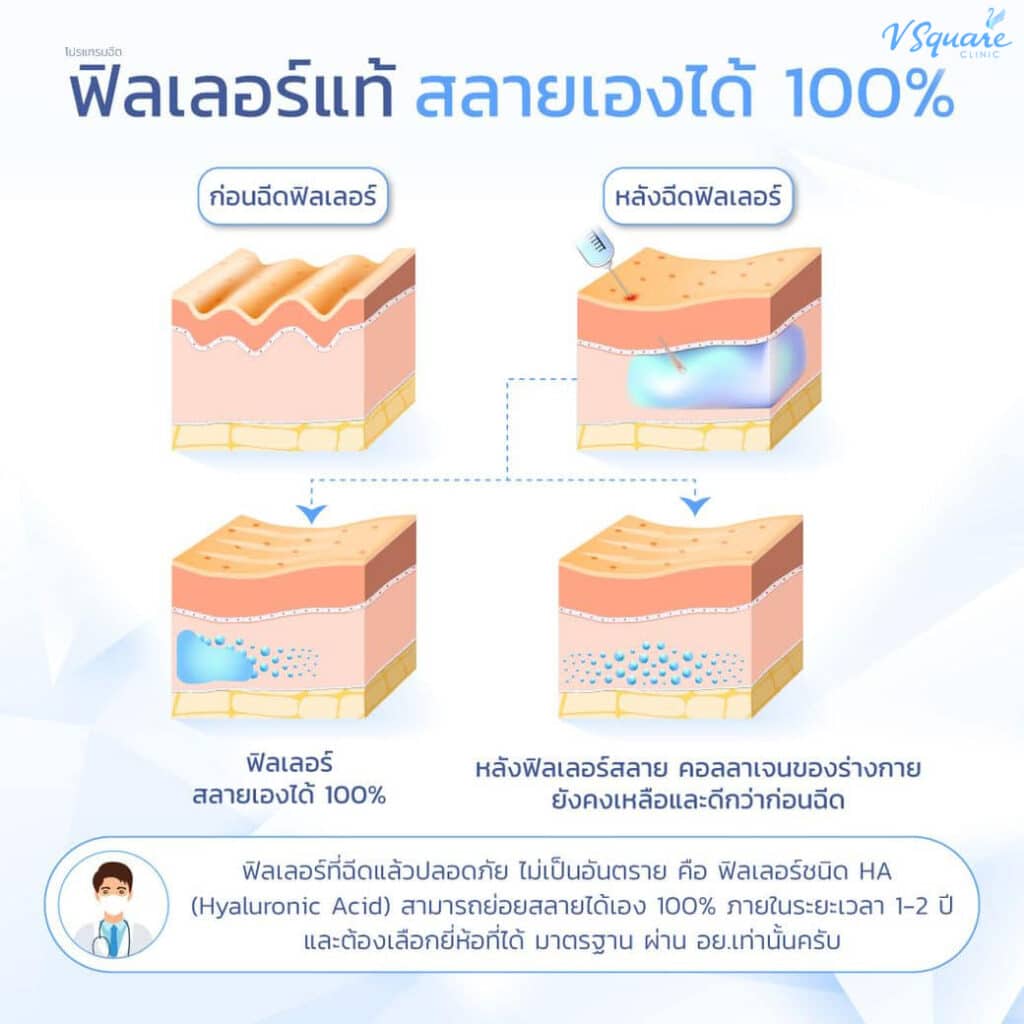 ฟิลเลอร์แท้ปลอดภัย