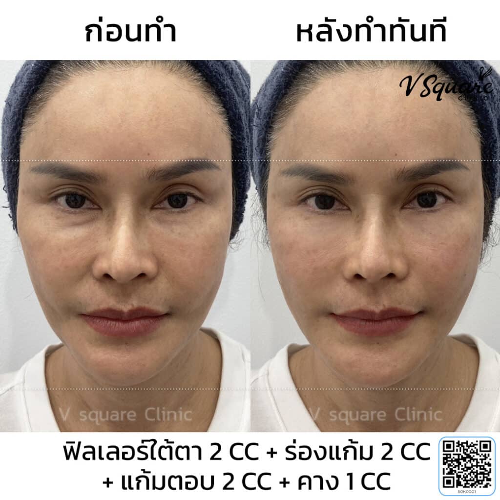 รีวิว ฉีด Filler คาง_มนัสนันท์ แสนจันทร์