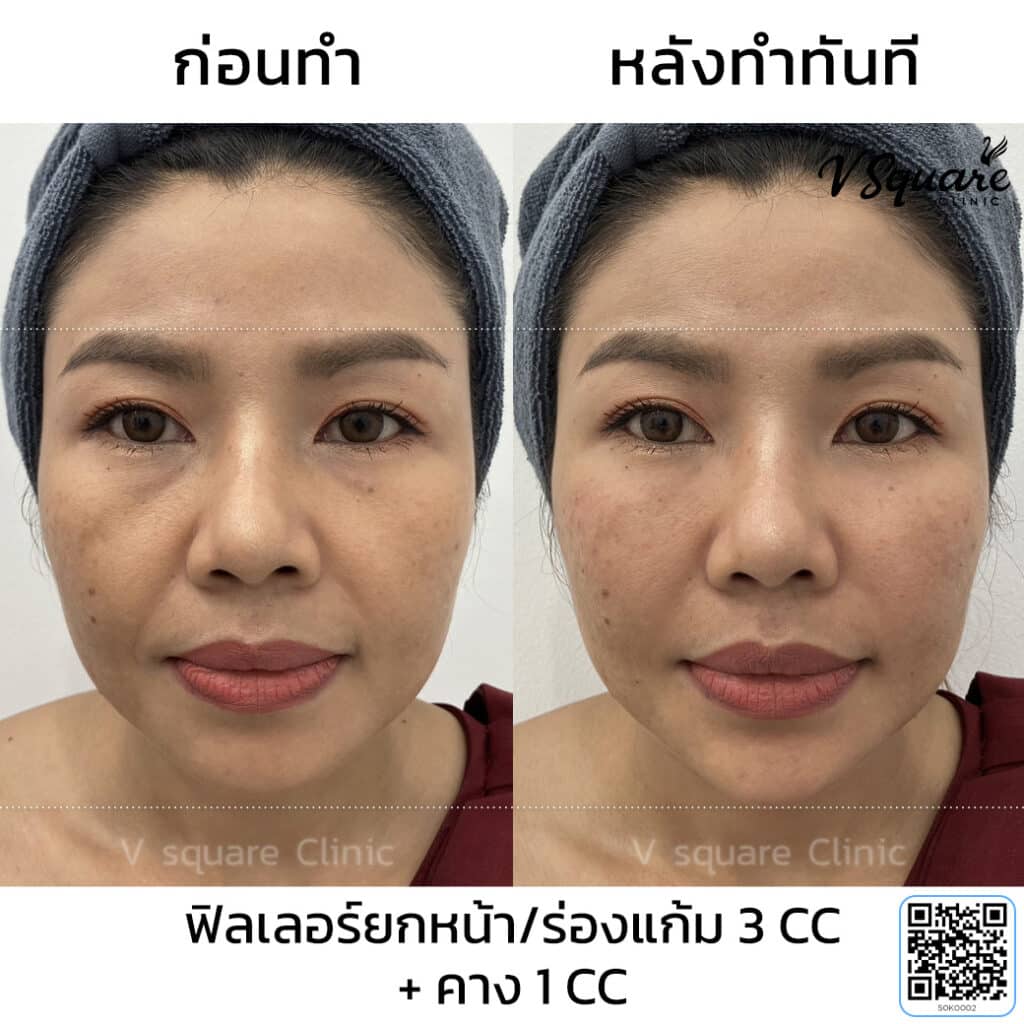 รีวิว ฉีดฟิลเลอร์คาง แก้คางยื่น_ศิวาการ ศรีรักษา