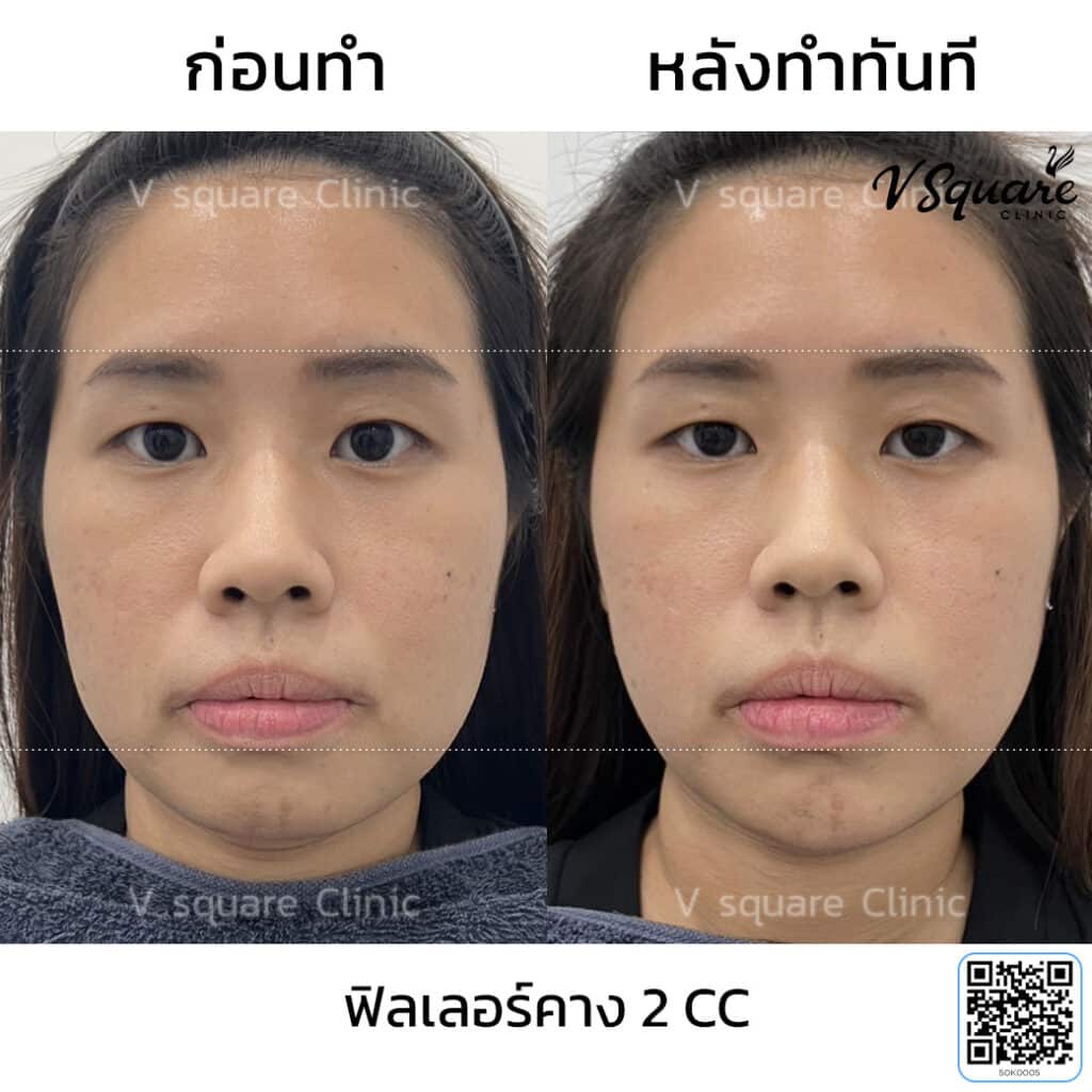 รีวิว ฉีดฟิลเลอร์คาง_ญาณิศา อินทร์ภิรมย์