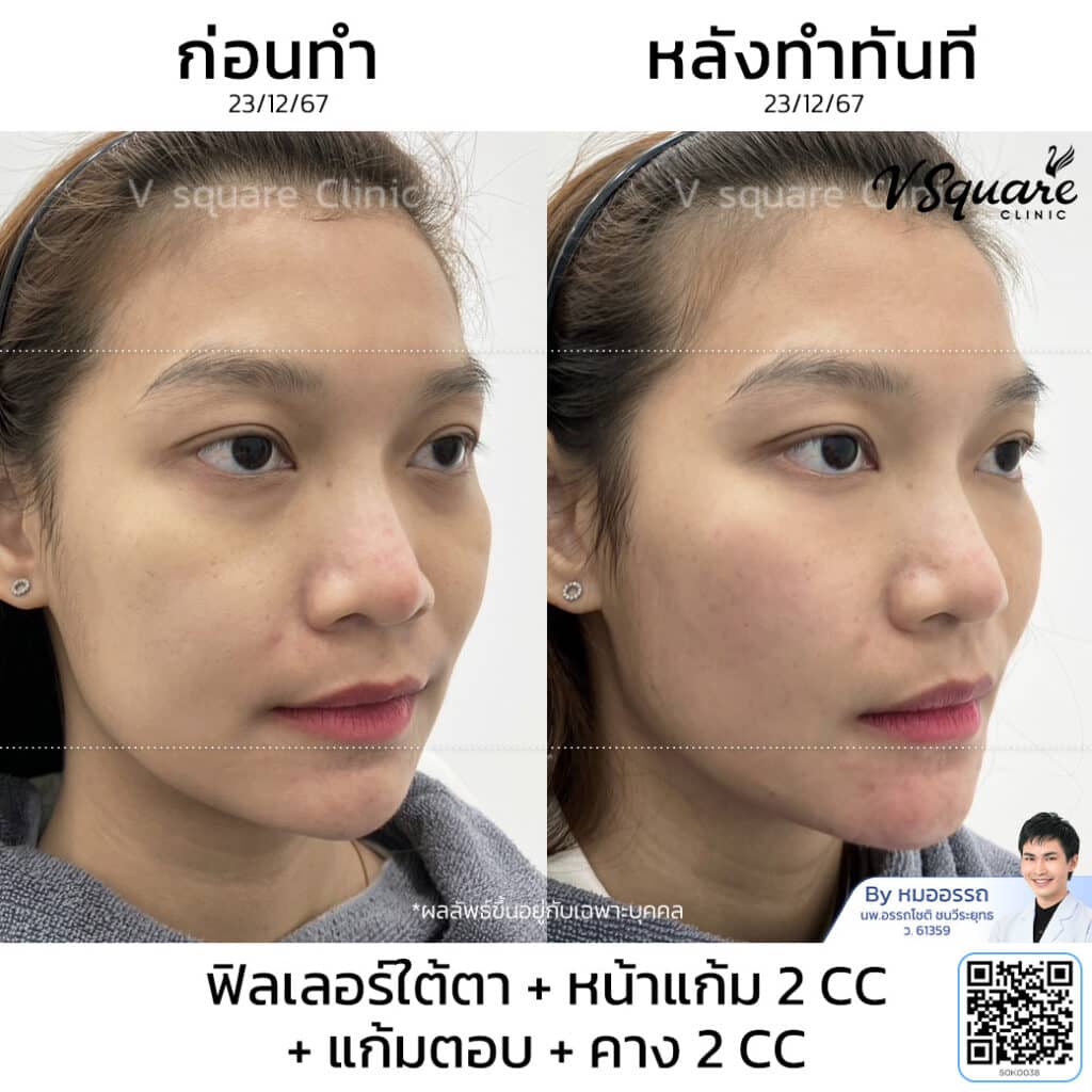 รีวิว ฉีดฟิลเลอร์หน้าแก้ม แก้มส้ม_สุมิตา ลักษณาวงศ์ โดย หมอ อรรถ