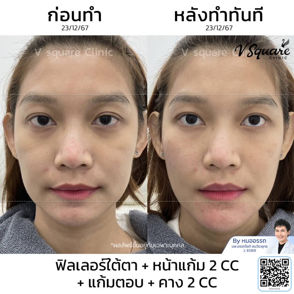 รีวิว ฉีดฟิลเลอร์หน้าแก้ม แก้มส้ม_สุมิตา ลักษณาวงศ์ โดย หมอ อรรถ