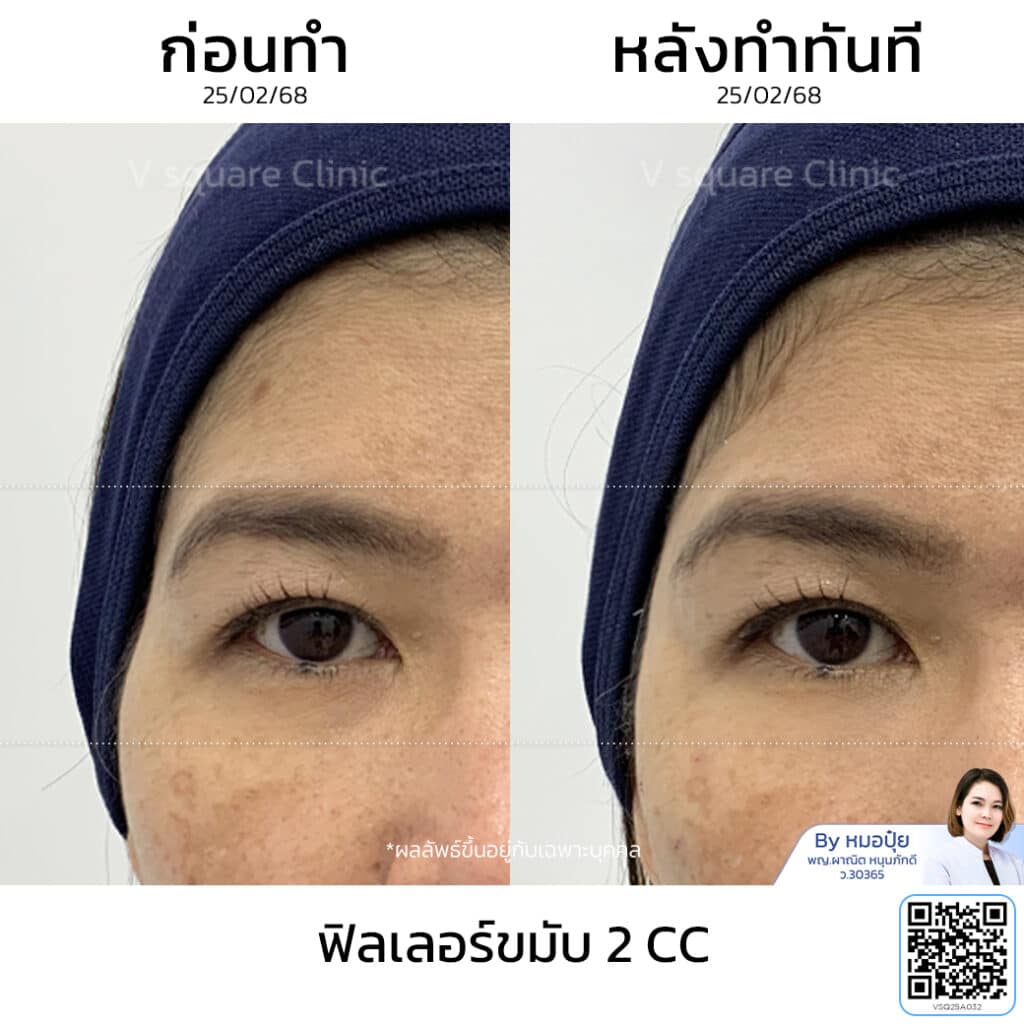 รีวิวฉีดฟิลเลอร์ขมับ_คุณหมวย โดย หมอ ปุ๋ย